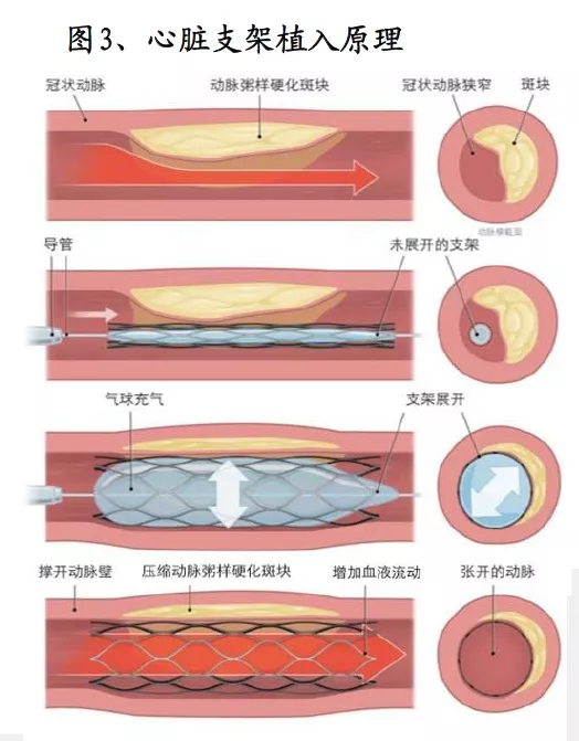 被卡脖子的，不只有芯片：医疗器械及材料为什么这么贵？